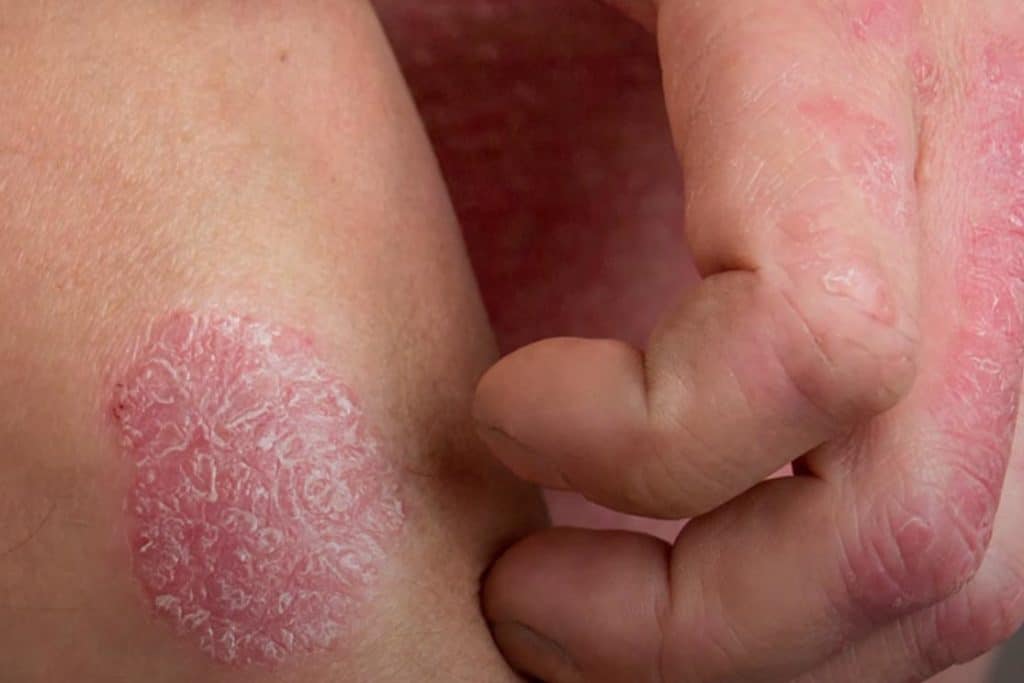 7 preguntas sobre el coronavirus cuando se sufre de eczema